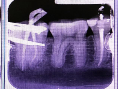 Root Canal (Difficult Cases)