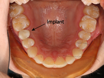 Severe Crowding And Congenital Missing Upper Left Second Premolar