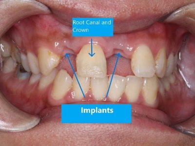 Trauma Case-Implant and Crown