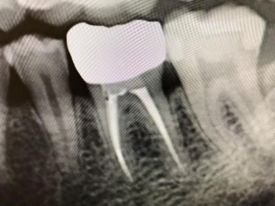 Root Canal (Difficult Cases)