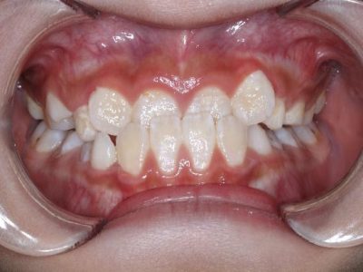 Severe Antrtiot Teeth Underbite