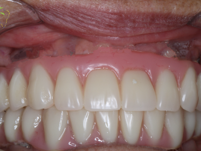 FourPoint Implants - Upper and Lower Arch Implants