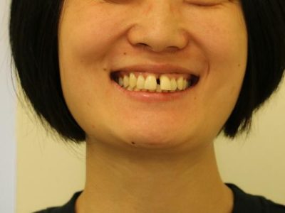 Server Displaced Front Teeth From Gum Disease