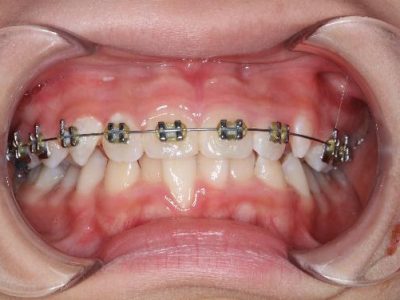 Anterior Teeth Patial Underbite