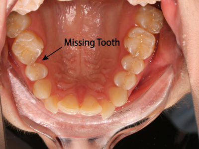Severe Crowding And Congenital Missing Upper Left Second Premolar