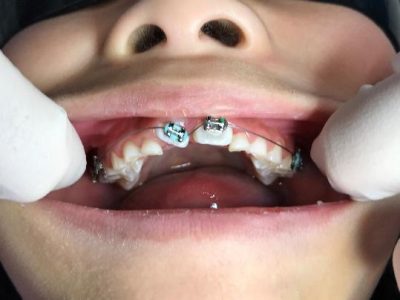 Twisted Underbite Single Upper Front Tooth