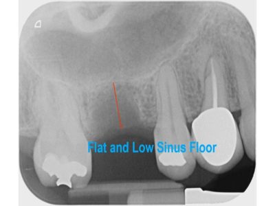 Single Implant with Sinus Lift