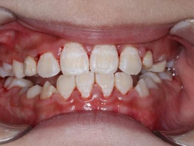 Severe Antrtiot Teeth Underbite