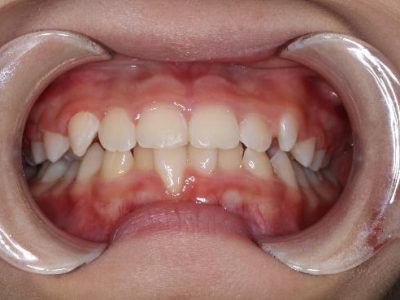 Anterior Teeth Patial Underbite