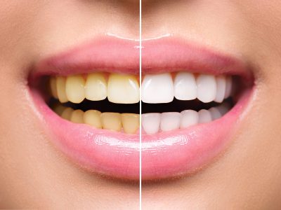 Woman teeth before and after whitening. Oral care
