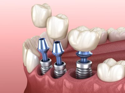 3 tooth crowns placement over 3 implants - concept. 3D illustration of human teeth and dentures