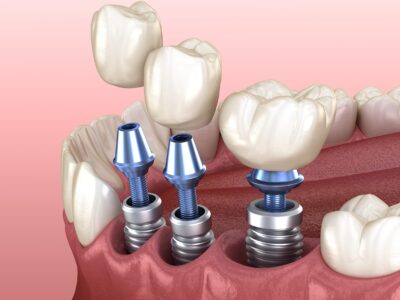 3 tooth crowns placement over 3 implants - concept. 3D illustration of human teeth and dentures 3 tooth crowns placement over 3 implants - concept. 3D illustration of human teeth and dentures