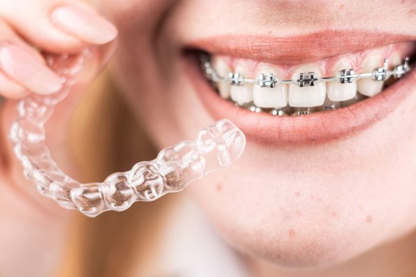 Dental care.Smiling happy girl with braces on her teeth holds aligners in her hands and shows the difference between them